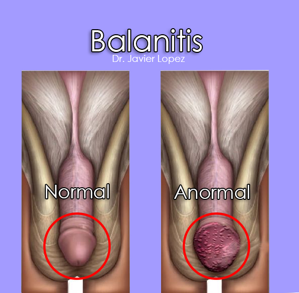 balanitis.jpg