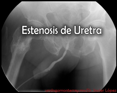 esternosis de uretre urologo urologia monterrey