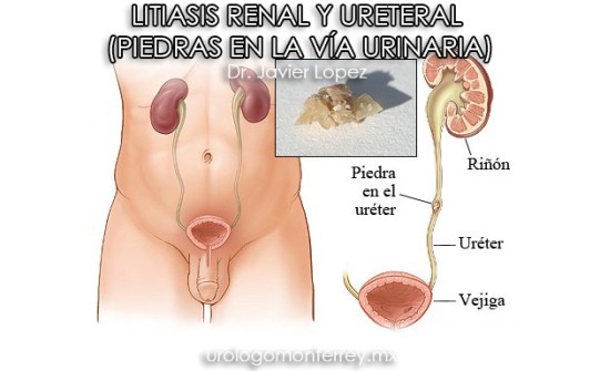 urologo urologia monterrey