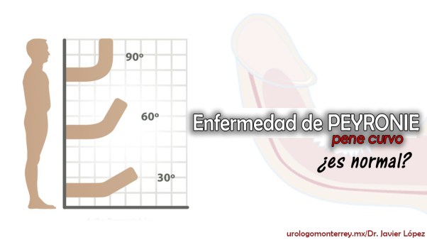 pene curvo por el urologo Dr. Javier Lopez