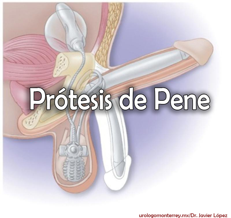 urologo urologia monterrey dr javier lopez