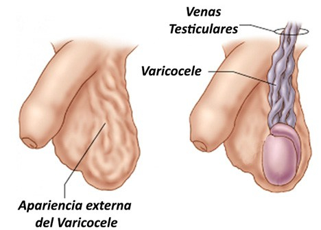 varicocele